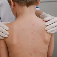Kiedy po ospie do przedszkola? Sprawdź, kiedy dziecko może wrócić